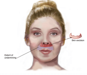 types of lip lifts - extended perialar lip lift